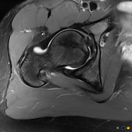 Figure 2 for case reverse slipped upper femoral epiphysis